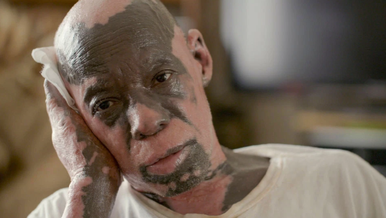 Neil Cobb phát hiện mình mắc bệnh lạ sau khi những mảng chàm nhỏ màu đen trên tay ông bắt đầu lan ra khắp toàn thân. 