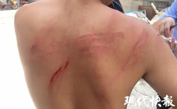 Lưng của anh Đoạn bị vợ đánh bị thương.