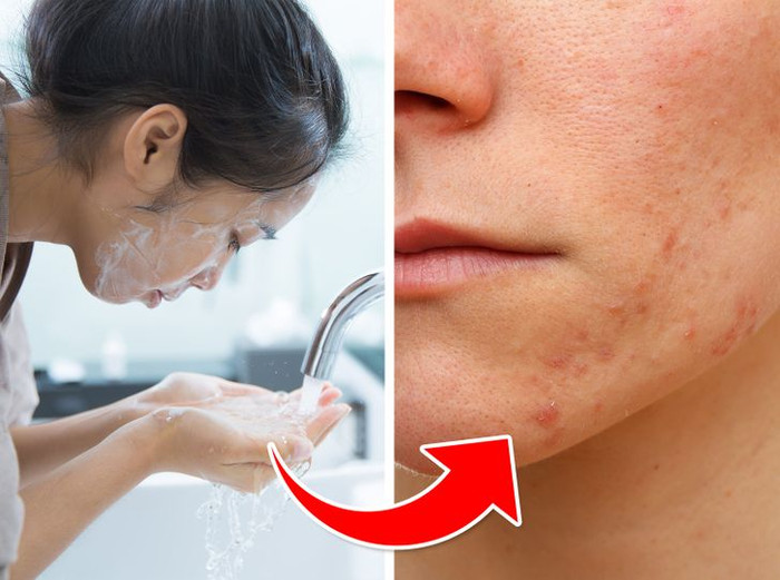 7 sai lầm skincare khiến mụn tới cản không kịp Ảnh 4