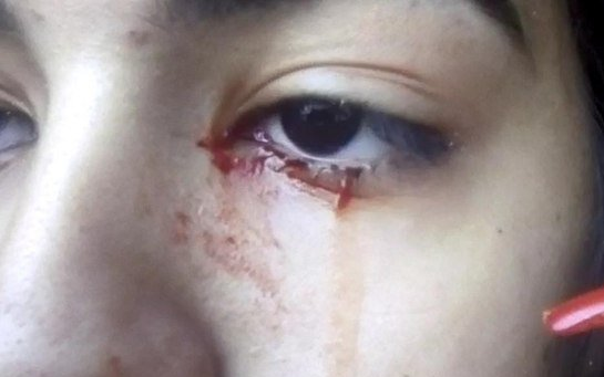 Bé gái khóc ra máu trong nhiều ngày nhưng các bác sĩ không thể lý giải Ảnh 2