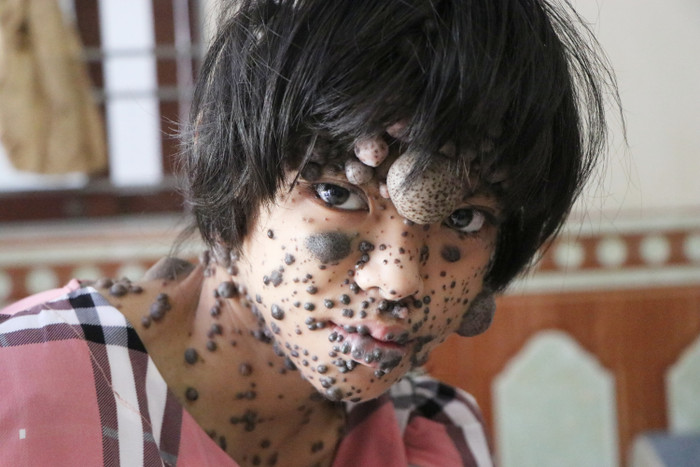 Trê cơ thể đầy khối u khiến ai nhìn Ly lần đầu cũng khiếp sợ.