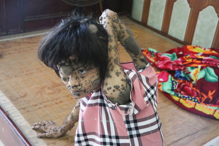 Nỗi xót xa thiếu nữ 16 tuổi mang thân hình 'quỷ', sống u sầu bởi ai nhìn cũng khiếp sợ Ảnh 4