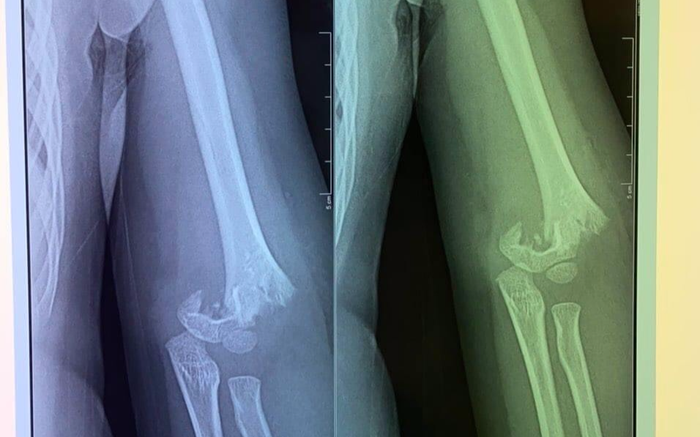 Ngã cầu trượt tại trường mầm non, bé gái 5 tuổi ở Hà Nội gãy lìa xương khuỷu tay Ảnh 2