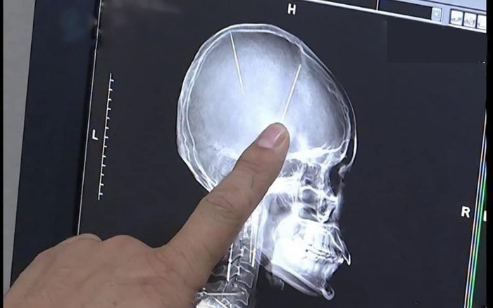 Đi chụp CT sau tai nạn xe, người phụ nữ bất ngờ phát hiện hai cây kim dài đâm sâu vào não Ảnh 2