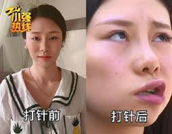 Chị Triệu trước vào sau khi bị liệt mặt. 