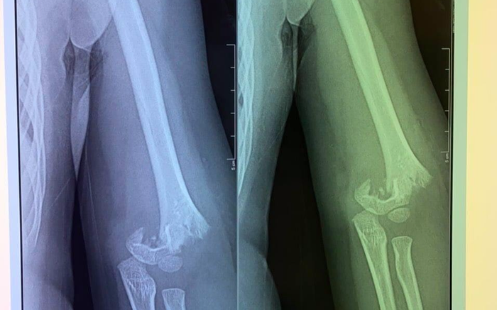 Sở GD&ĐT Hà Nội yêu cầu xác minh làm rõ vụ bé gái 5 tuổi ở gãy lìa xương khuỷu tay ở trường mầm non Ảnh 2