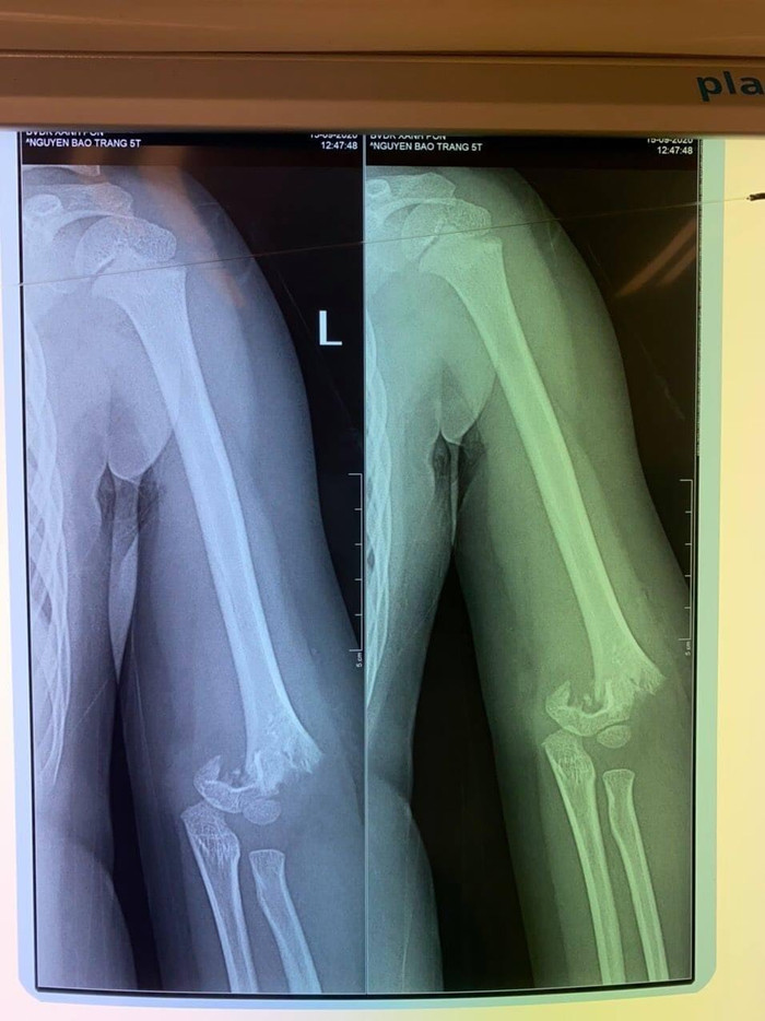 Hình ảnh xương khuỷu tay bé gái bị gãy lìa.