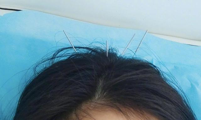 Công việc quá bận rộn khiến Dương Mịch và Triệu Lệ Dĩnh đổ bệnh: Người phải uống thuốc bắc, kẻ dùng châm cứu để chữa trị Ảnh 5