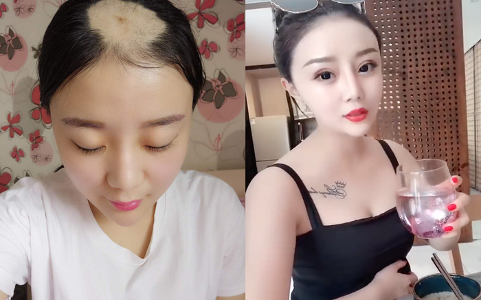 Hotgirl 'hói đầu' vì ăn ngô bằng khoan, công khai hình ảnh 'dao kéo' khiến fan quay lưng Ảnh 2