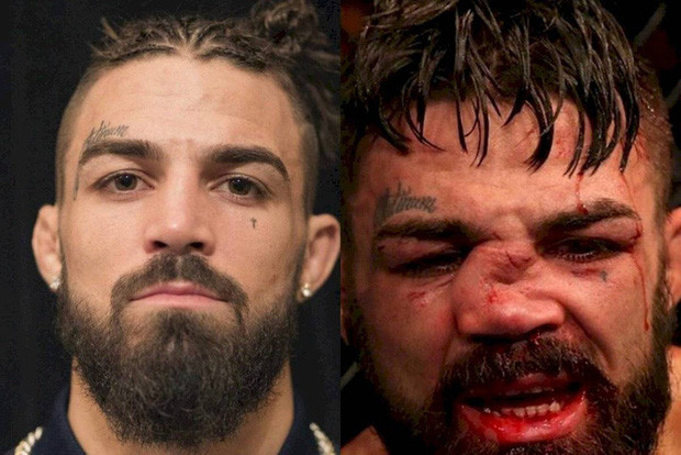 Võ sĩ Mike Perry từng dính chấn thương tương tự.