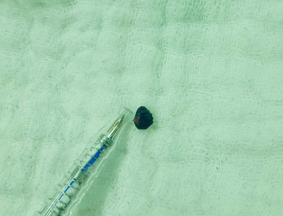 Mẫu đất sét được lấy ra ngoài. Ảnh: Bệnh viện cung cấp