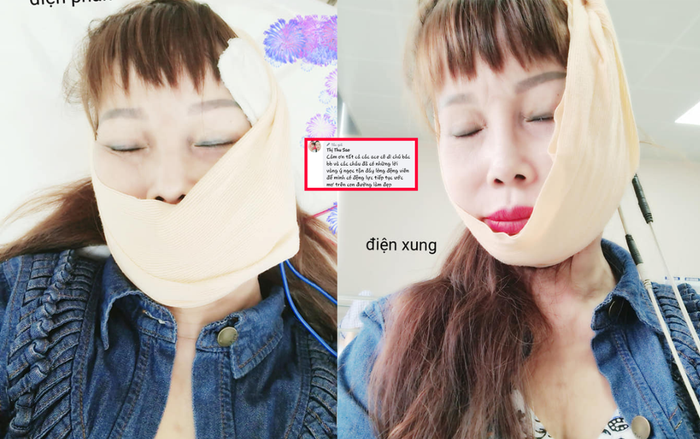 Gặp biến chứng thẩm mỹ, 'cô dâu 62 tuổi' phải chạy vật lí trị liệu nhưng khẳng định sẽ tiếp tục ước mơ làm đẹp Ảnh 2