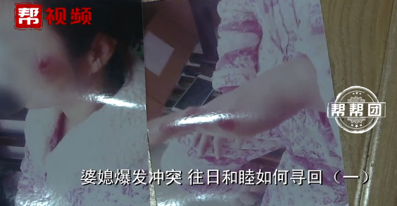 Thương tích trên người chị San San do chồng đánh.&nbsp;