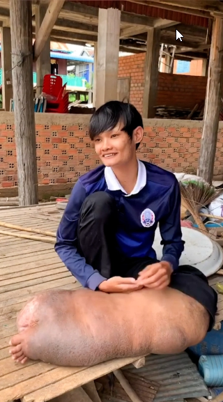 Bị muỗi đốt, chàng trai phải sống với một bên chân sưng phù 'quái dị' suốt 21 năm Ảnh 3