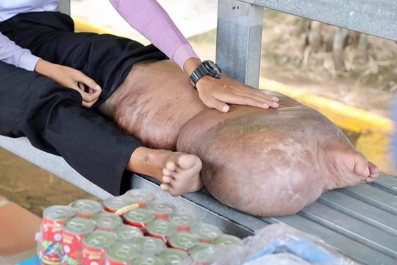 Bị muỗi đốt, chàng trai phải sống với một bên chân sưng phù 'quái dị' suốt 21 năm Ảnh 4