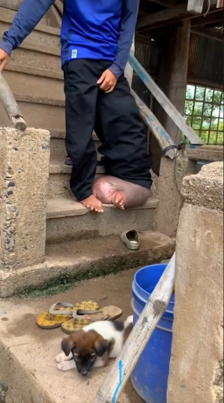 Bị muỗi đốt, chàng trai phải sống với một bên chân sưng phù 'quái dị' suốt 21 năm Ảnh 7