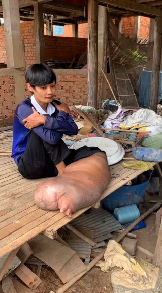 Bị muỗi đốt, chàng trai phải sống với một bên chân sưng phù 'quái dị' suốt 21 năm Ảnh 8