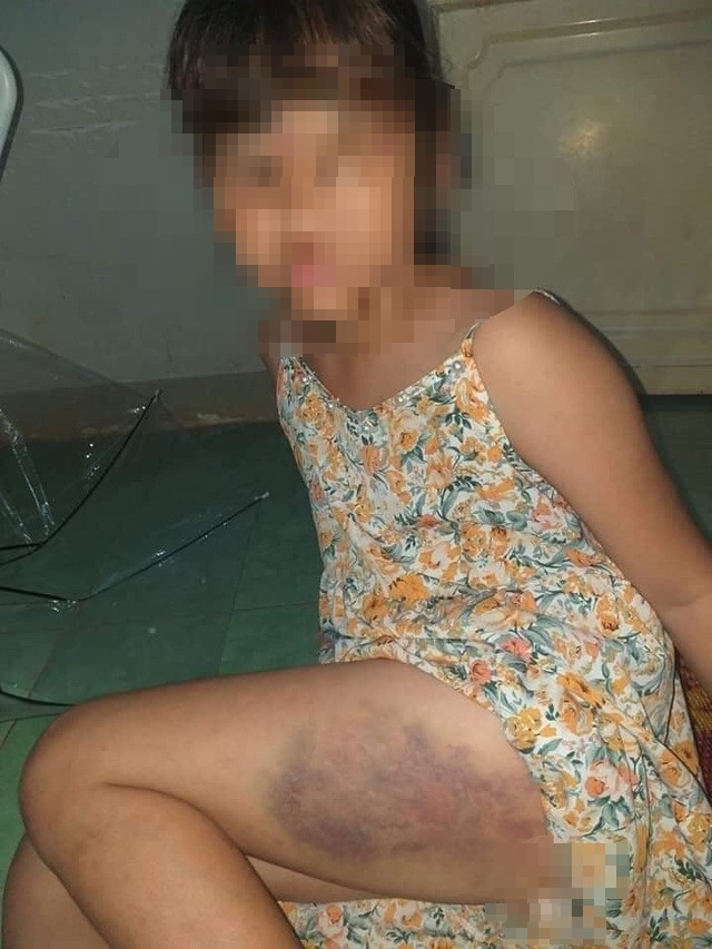 Hình ảnh em học sinh bị bầm tím phần đùi do bị cô giáo dùng thước gỗ đánh