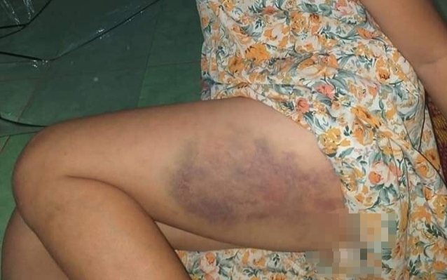 Xác minh thông tin cô giáo dùng thước gỗ đánh học sinh lớp 3 bầm tím đùi ở Đắk Lắk Ảnh 2