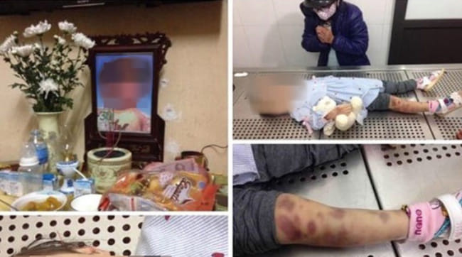 Hình ảnh thương tích trên người cháu bé.