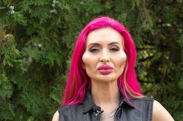 'Nghiện' tiêm filter suốt 4 năm, nàng mẫu có 'gò má cao nhất thế giới' vẫn thấy chưa 'đủ đô' Ảnh 5