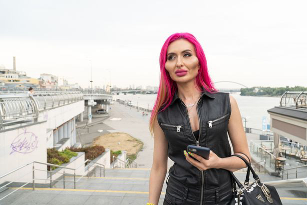 'Nghiện' tiêm filter suốt 4 năm, nàng mẫu có 'gò má cao nhất thế giới' vẫn thấy chưa 'đủ đô' Ảnh 7