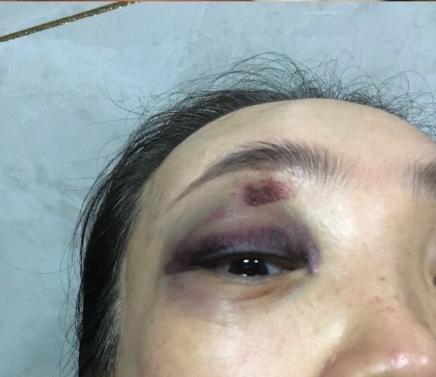 Những vết thương của mẹ và dì cô khi Trương Bồi Manh thuê người đến cướp con