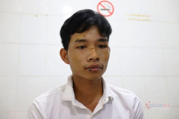Khuôn mặt nhiều vết trầy xước của anh Hồ Văn Thoàn. Ảnh: Vietnamnet