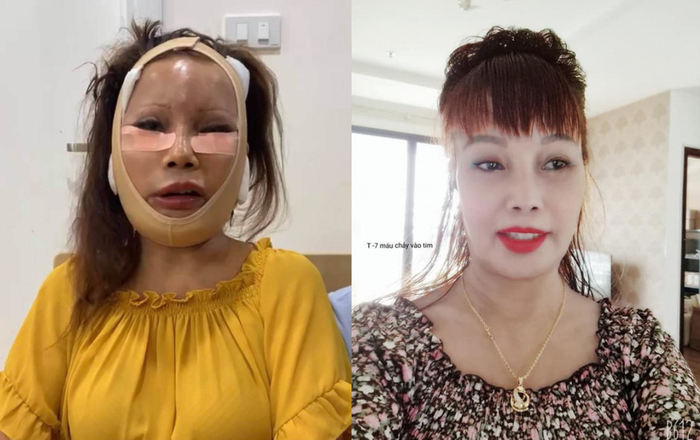 Ngỡ ngàng với nhan sắc 'cô dâu 62 tuổi' sau khi chạy vật lí trị liệu vì biến chứng thẩm mỹ Ảnh 2