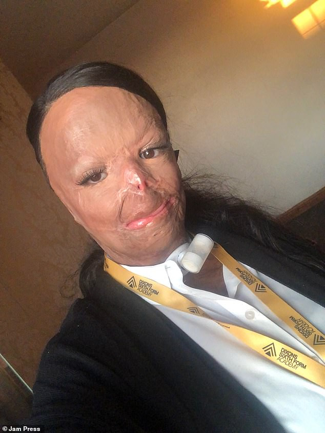 Aleema bị biến dạng hoàn toàn khuôn mặt sau vụ cháy.