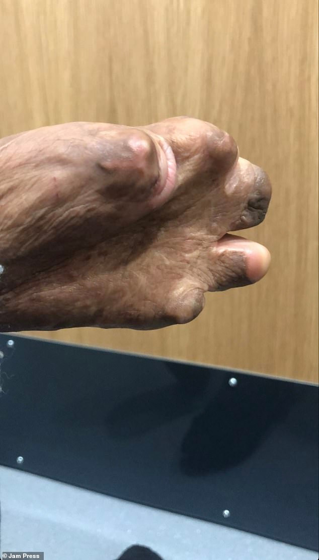 Aleema bị cháy hết các ngón tay.