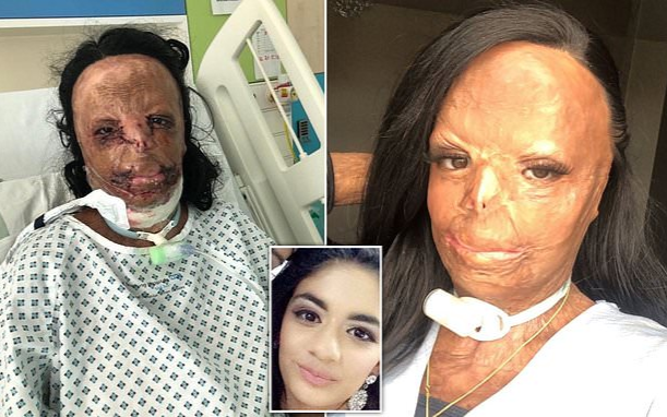 Dầu gội trị chấy bắt lửa nhấn chìm cô gái tuổi teen trong biển lửa, bỏng cấp độ 3 và mất 7 ngón tay Ảnh 2