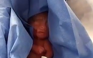 Bị tưởng lầm đã chết, em bé sinh non phải nằm trong tủ đông nhà xác suốt 6 giờ Ảnh 2