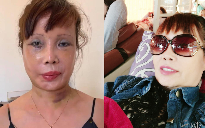 'Cô dâu 62 tuổi' gây bất ngờ với diện mạo mới sau thời gian vật lý trị liệu vì biến chứng phẫu thuật Ảnh 2