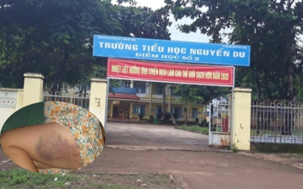 Xử phạt nữ giáo viên đánh bầm đùi học sinh hơn 3,7 triệu đồng, đình chỉ dạy 3 tháng Ảnh 2