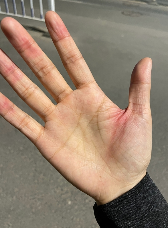 Tay người dùng đỏ lên sau khi cầm máy iPhone mới. Ảnh: Weibo