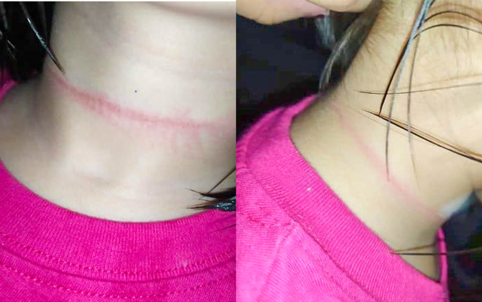 Bé gái 4 tuổi suýt mất mạng khi cố thực hiện theo thử thách treo cổ trên TikTok Ảnh 2