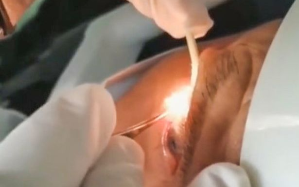 Rùng mình khoảnh khắc bác sĩ gắp 20 con giun khỏi mắt bệnh nhân Ảnh 2