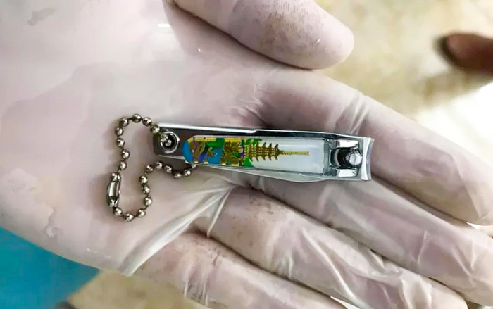 Học theo video trên YouTube, bé 9 tuổi ở Phú Thọ nuốt bấm móng tay vào bụng Ảnh 2