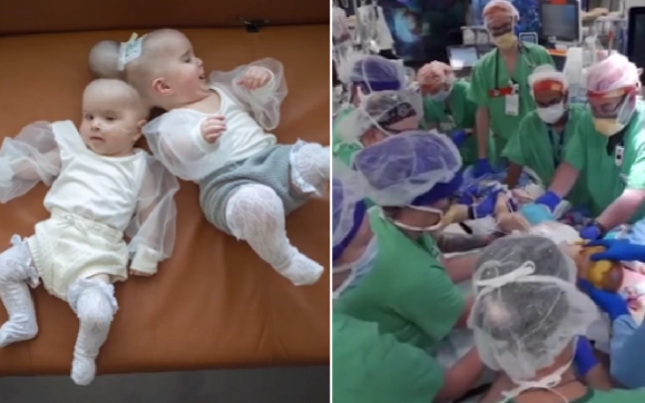 24 tiếng tách rời cặp song sinh dính liền Ảnh 2