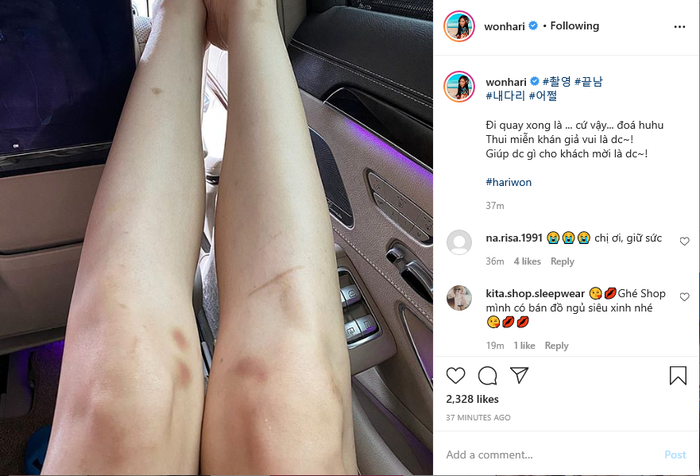 Mới đây, người hâm mộ không khỏi lo lắng khi thấy những vết bầm tím xuất hiện trên đôi chân trắng ngần của nữ ca sĩ. Thế nhưng, có ngờ đâu, đó là kết quả của việc 'hết mình' trong các chương trình mà cô tham gia.  