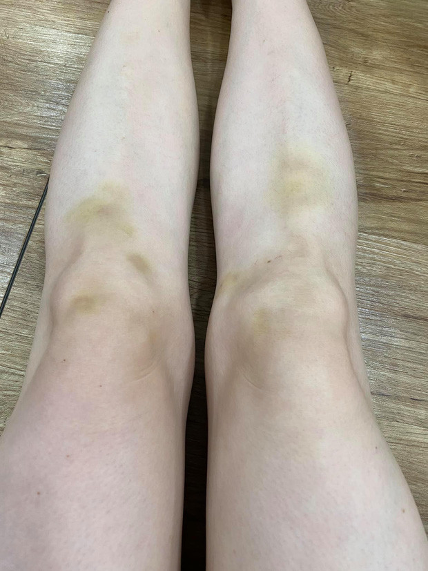 Thế nhưng chắc do lần đầu tham gia nên Lý Nhã Kỳ đã vô cùng phấn khích đến mức... bầm dập có 2 chân. Người đẹp chia sẻ: 'Trời ơi tin được không? Ngồi chơi Nhanh Như Chớp tung tăng tung tóe quá, nhún nhảy quá rồi về mới phát hiện hậu quả mình tự gây ra'. Chỉ ngồi chơi mà còn bầm tím thề này thì sau còn 'te tua' thế nào nữa cô Kỳ ơi.