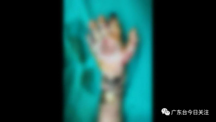 Bàn tay của Vĩ Hào bị nhiễm trùng và hoại tử.