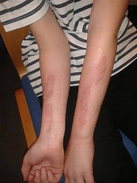 Một phụ huynh sống tại Fife, Scotland đã chia sẻ hình ảnh về những 'vết sẹo vĩnh viễn' mà con gái cô phải chịu đựng sau khi tham gia thử thách. (Ảnh: The Sun)