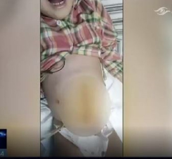 Bé gái bị bố đánh tới rách ruột, phải nằm trong phòng chăm sóc đặc biệt. 