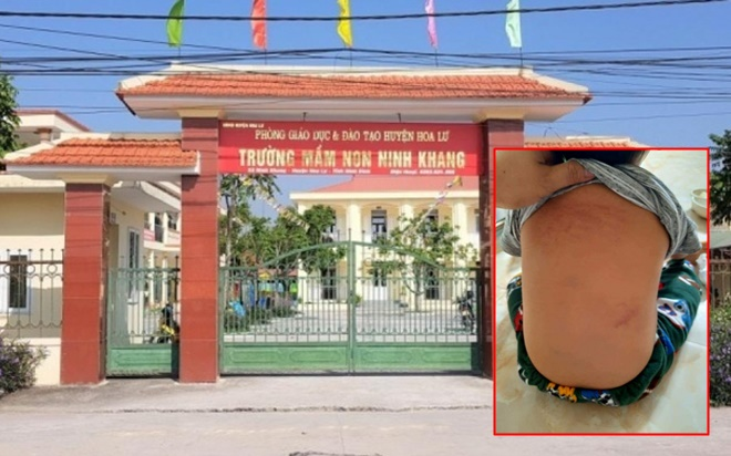Trẻ mầm non 15 tháng tuổi bị giáo viên bạo hành trong nhà vệ sinh, dọa cho uống nước bồn cầu Ảnh 2