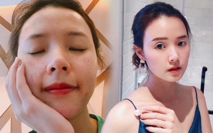 Midu khiến dân mạng 'dậy sóng' khi tiết lộ ảnh mặt mộc chi chít mụn Ảnh 2
