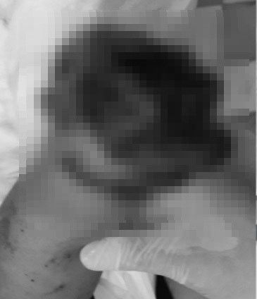 Trong quá trình dùng bình gas mini khò thịt nấu ăn, người đàn ông bất ngờ bị mất bàn tay phải, bỏng vùng mặt cổ do bình gas phát nổ.