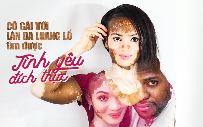 Cô gái với làn da loang lổ khắp người tìm được tình yêu đích thực Ảnh 2