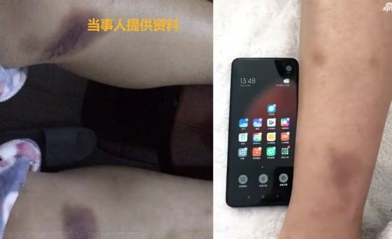 Tiểu Vân bị chồng đánh bầm dập khi đi đánh ghen.